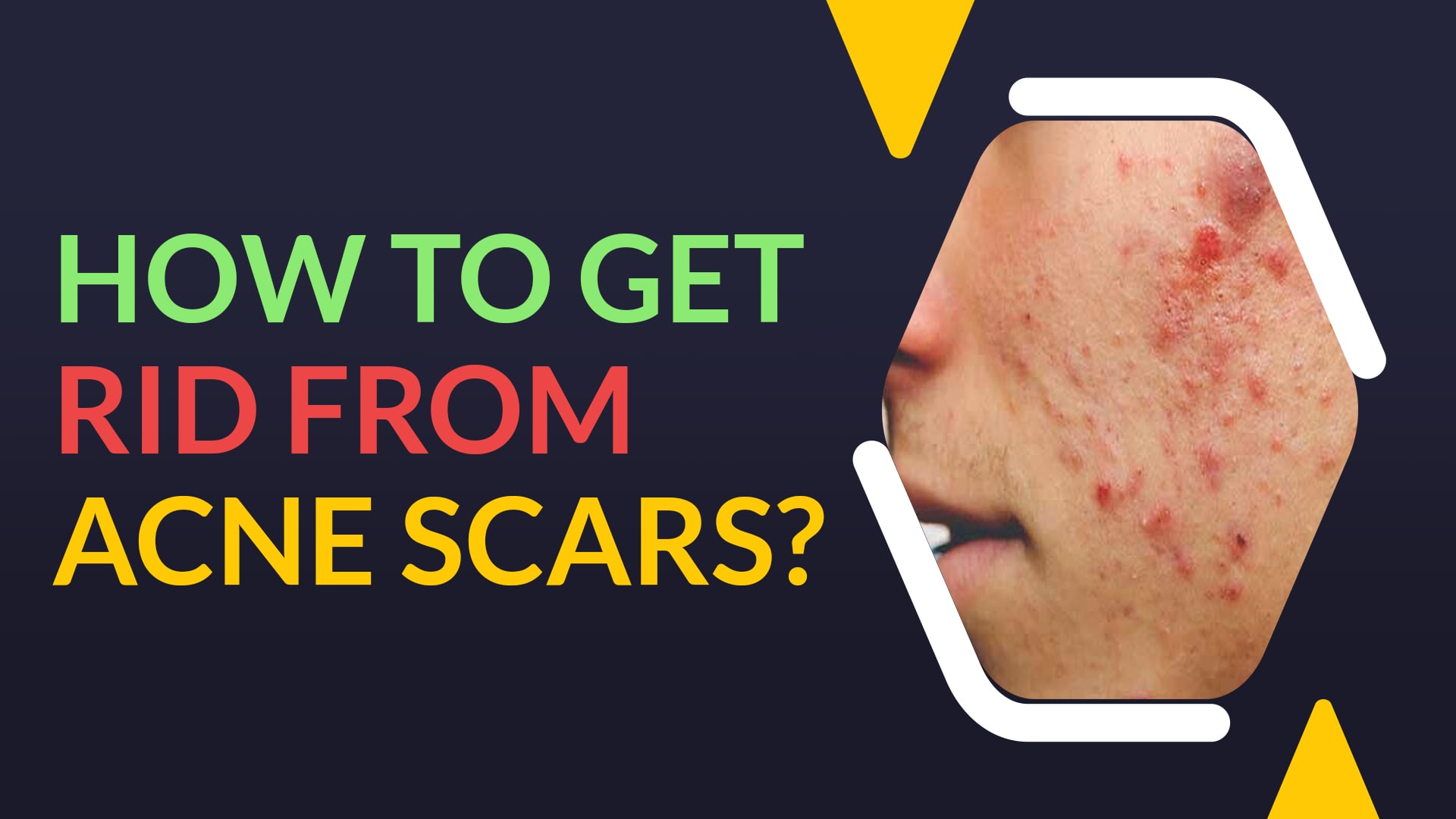 get rid from acne scars